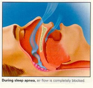 Sleep apnea treatment options